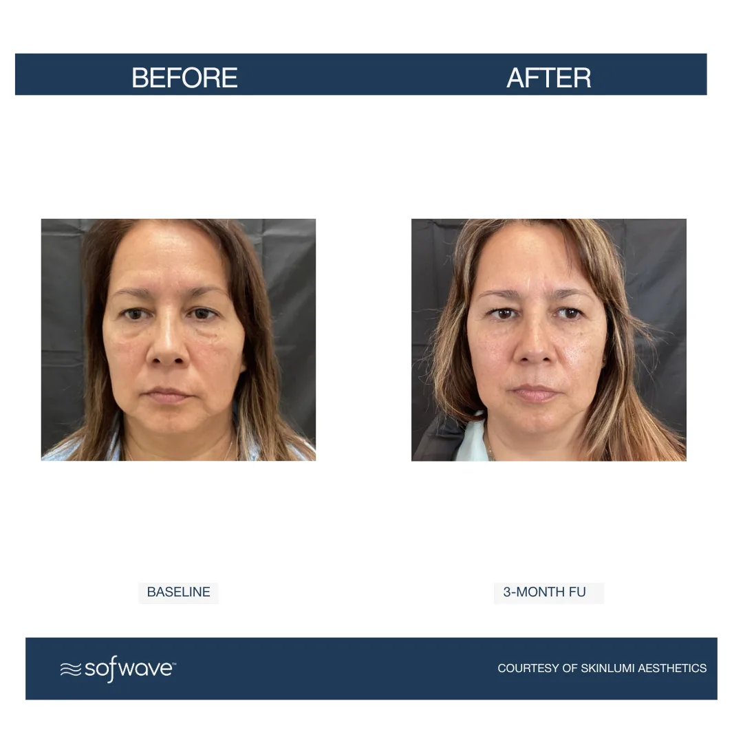 Sofwave™ Full Face